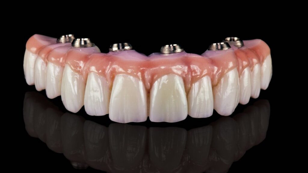 All-on-4 Implants: How Long does it last? All-on-4 Implants: How Long does it last?