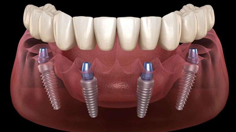 All on Four Implant Treatment in Turkey All on Four Implant Treatment in Turkey