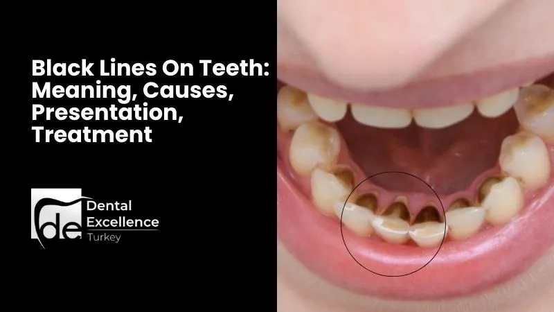 Black Lines On Teeth: Meaning, Causes, Presentation, Treatment Black Lines On Teeth: Meaning, Causes, Presentation, Treatment