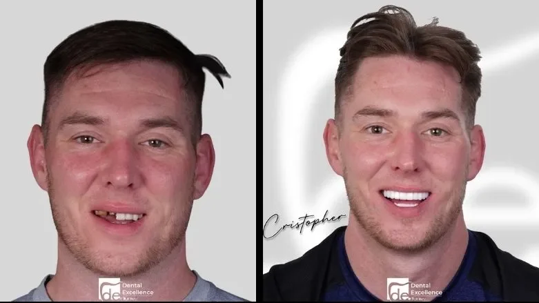 Can you get veneers with missing teeth? Can you get veneers with missing teeth?