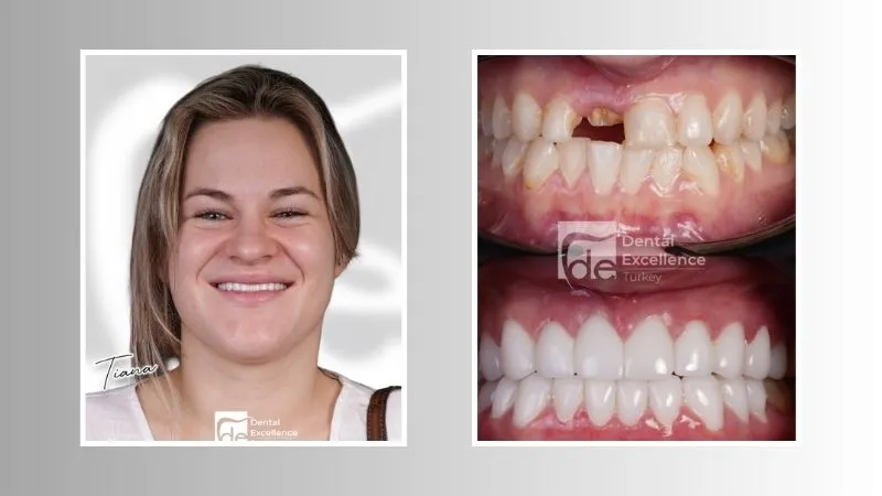 What Do Dental Implants Look Like? What Do Dental Implants Look Like?