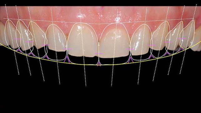 Benefits of Digital Smile Design Benefits of Digital Smile Design