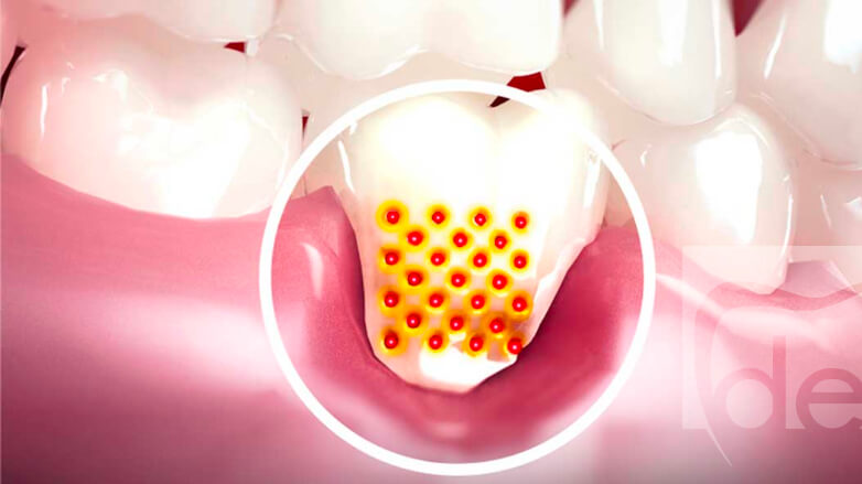 Gingival Recession Causes, Consequences, and Solutions Gingival Recession Causes, Consequences, and Solutions