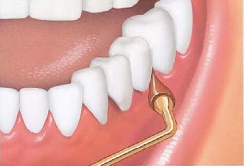 Tooth Decay Treated