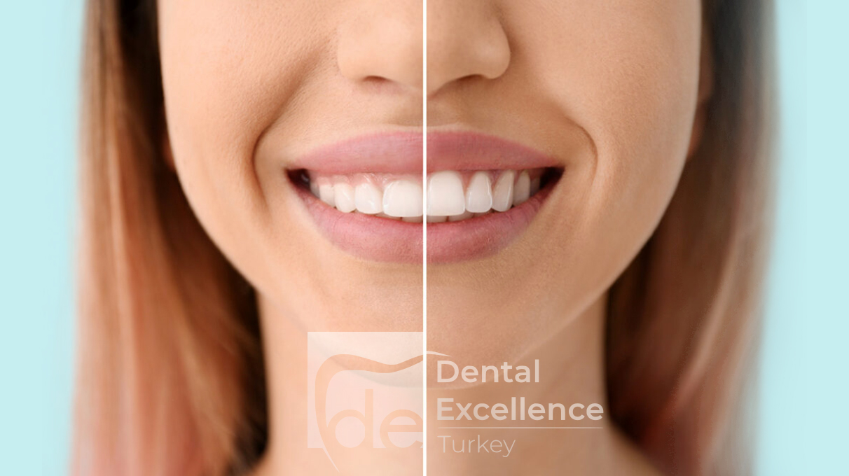 End Gummy Smile Problem with Botox! End Gummy Smile Problem with Botox!