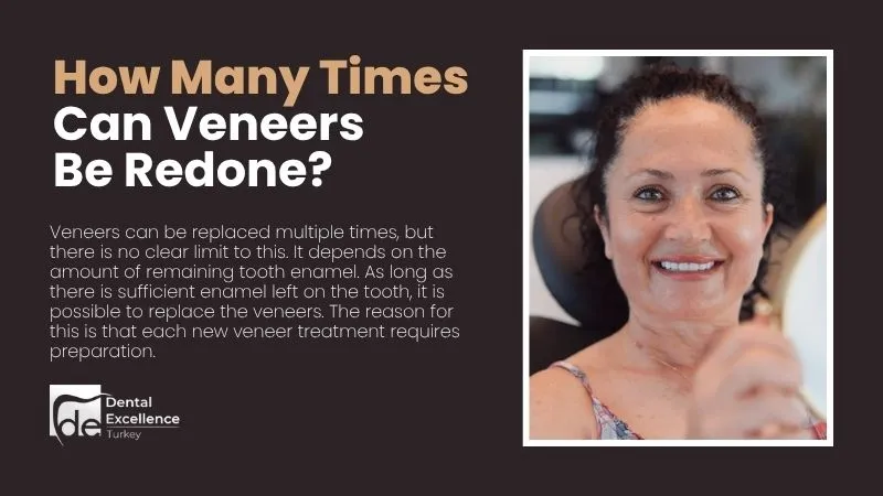 How Many Times Can Veneers Be Redone How Many Times Can Veneers Be Redone?