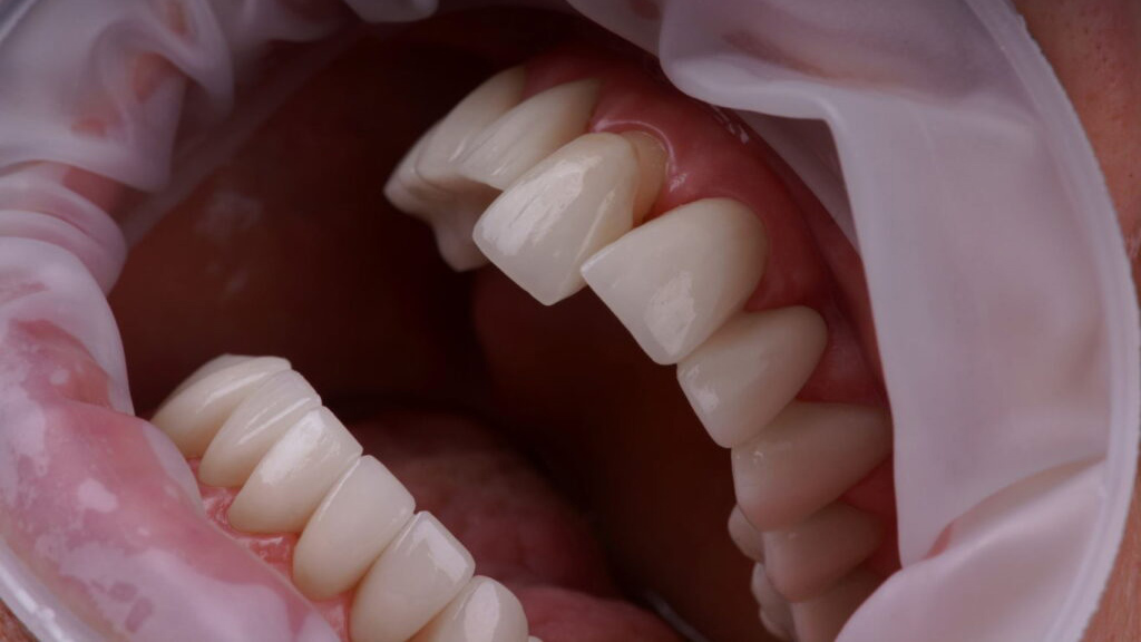 How much are Veneers in Turkey? How much are Veneers in Turkey?