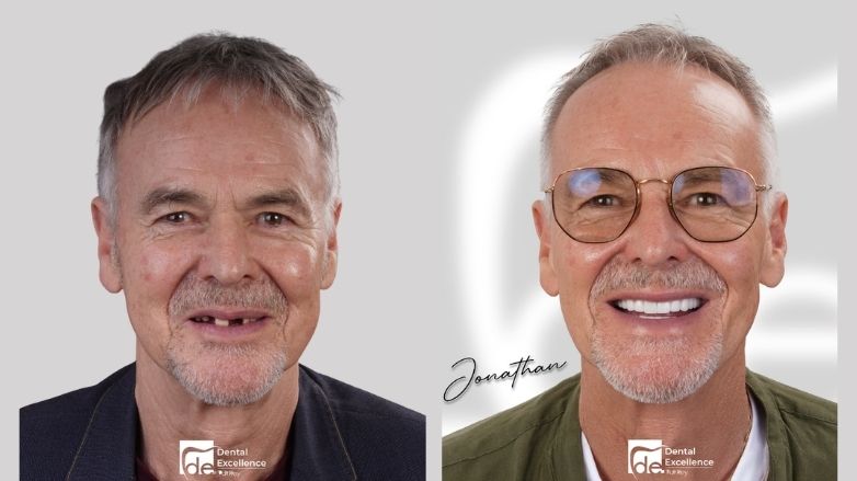 How to heal faster after dental implants? How to heal faster after dental implants?