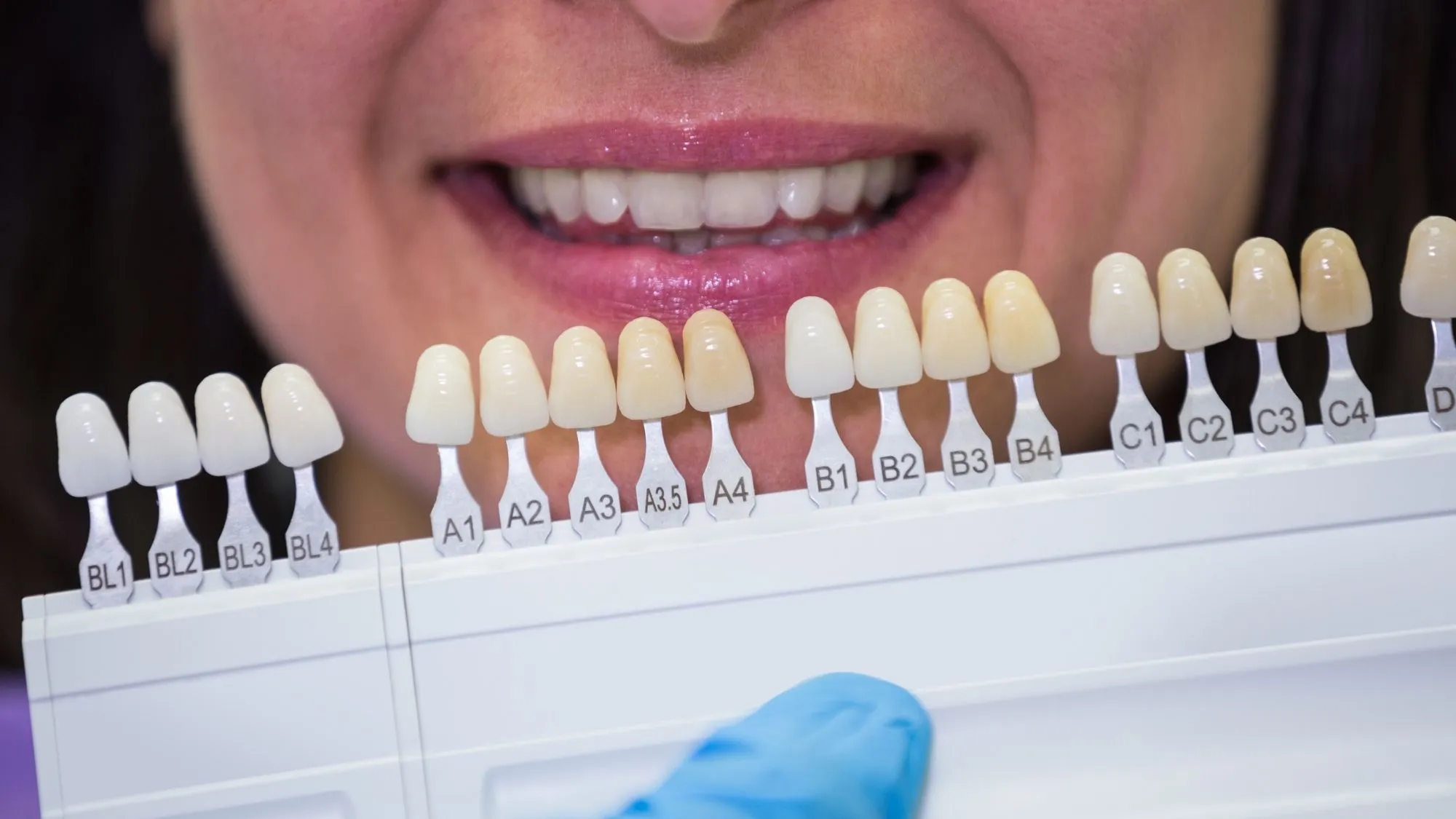 Is A1 Tooth Shade too White Is A1 Tooth Shade too White
