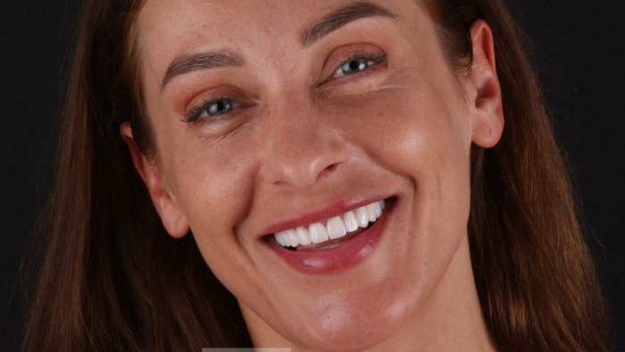 Porcelain Veneers for Crooked Teeth Porcelain Veneers for Crooked Teeth