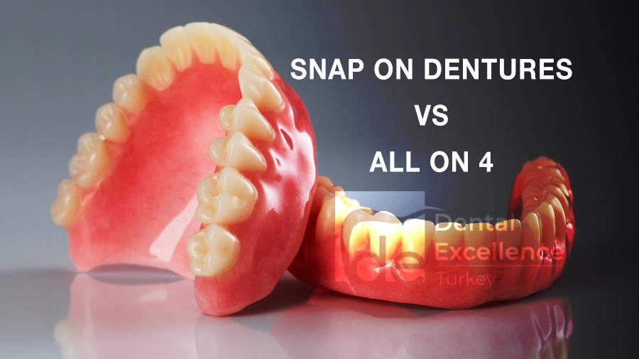 Snap on dentures vs all on 4 Snap on dentures vs all on 4
