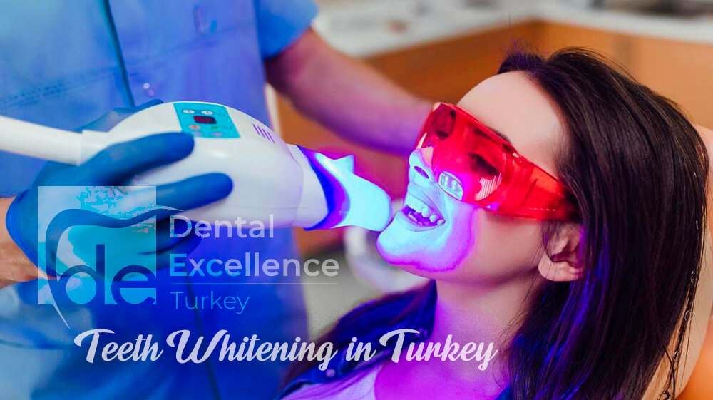 Teeth Whitening in Turkey, The Definitive Guide Teeth Whitening in Turkey, The Definitive Guide