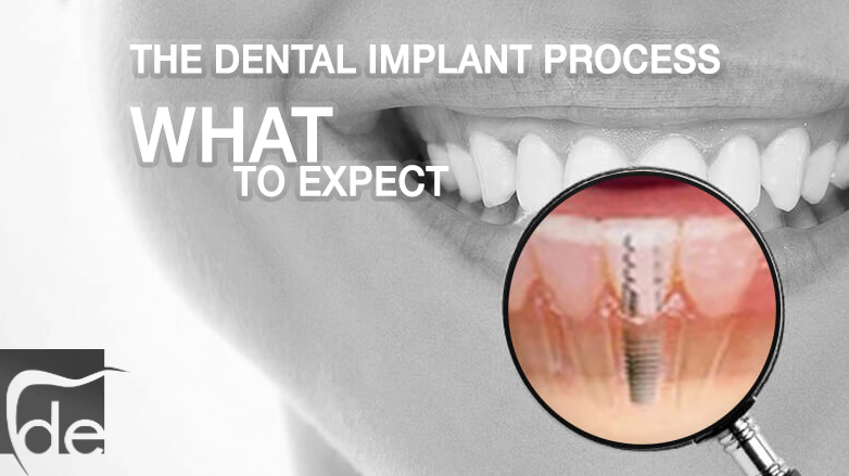 The Dental Implant Process: What to Expect The Dental Implant Process: What to Expect