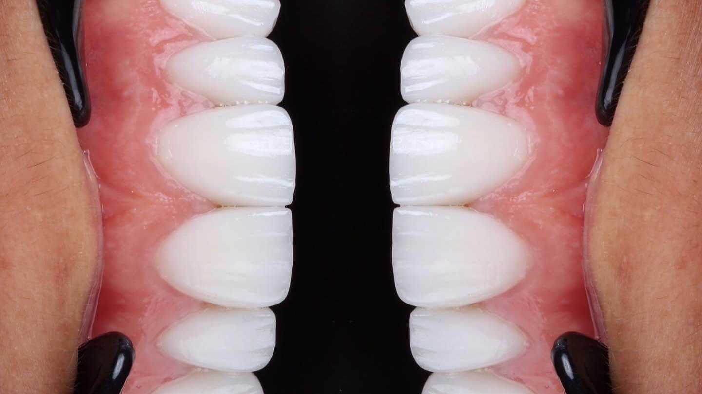 Veneers in Turkey Veneers in Turkey