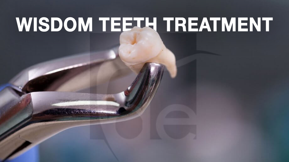 Everything You Need to Know About Wisdom Teeth Treatment in Turkey Everything You Need to Know About Wisdom Teeth Treatment in Turkey
