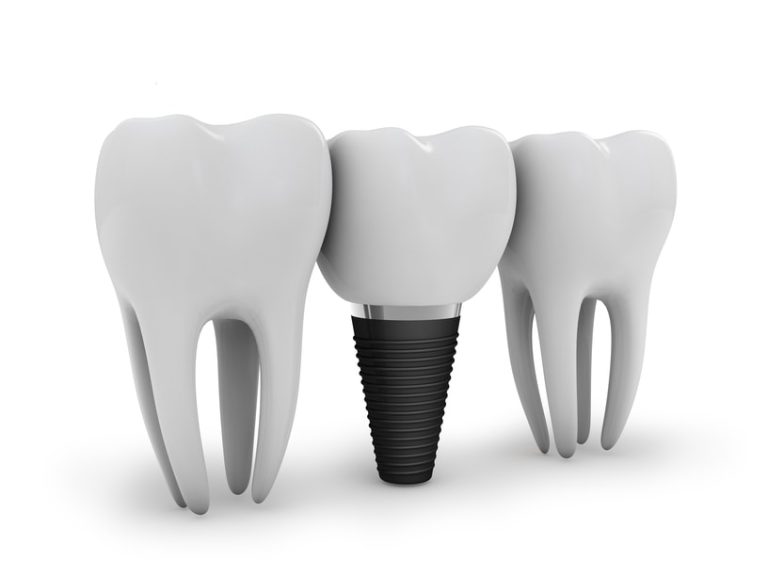 implant-operation implant-operation