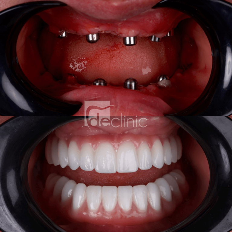 implant-operation implant-operation
