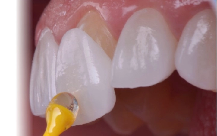 implant-operation implant-operation